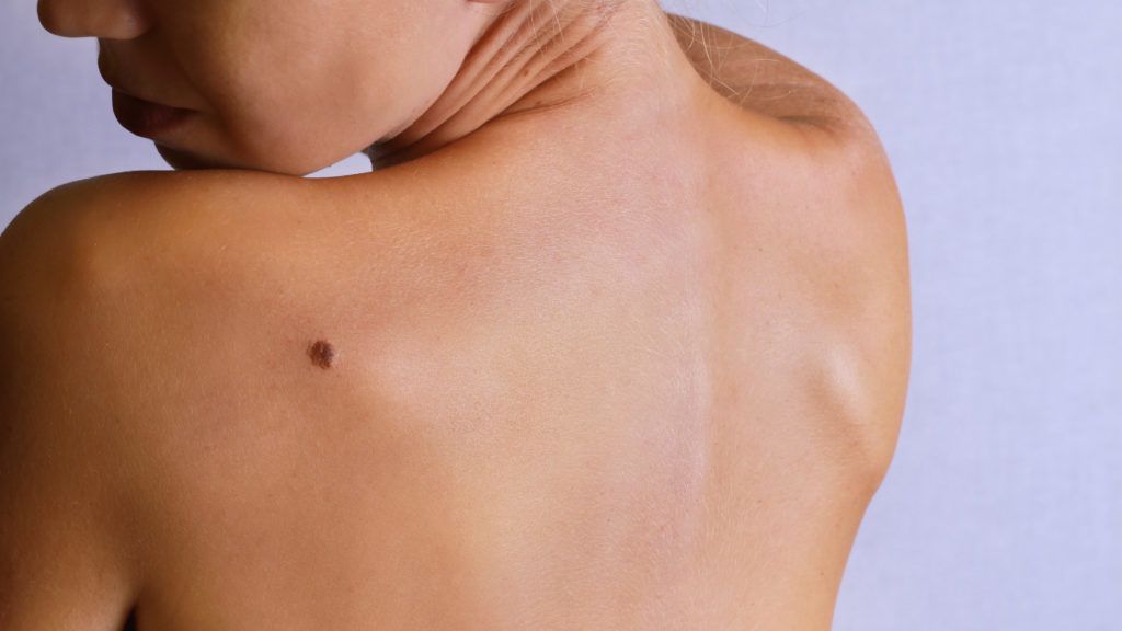 Одесситы могут бесплатно проверить кожу на рак