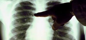 В Киеве можно будет бесплатно проверить легкие: где и когда