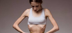 Отказывалась кушать: в Одессе от анорексии умерла 13-летняя девочка