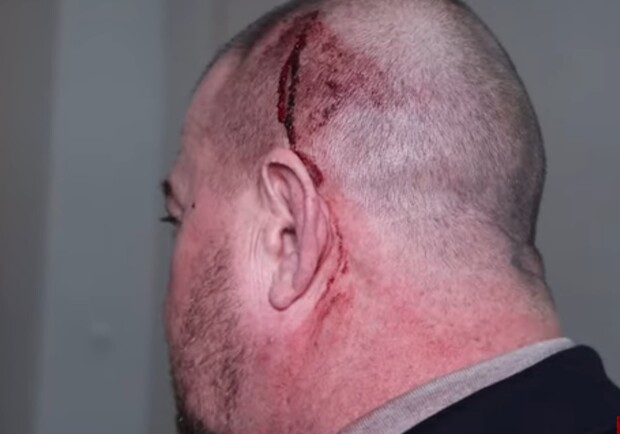 Нардеп Артем Дмитрук разбил голову директору охраны. 