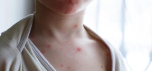 У МОЗ розповіли, яка імовірність поширення в Україні мавпячої віспи