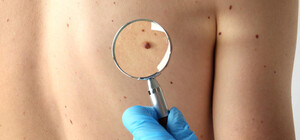 Отримай відповідь: де в Одесі можна буде безкоштовно перевірити родимку