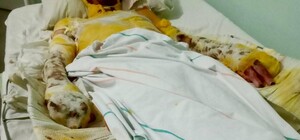 Было обожжено 65% тела: в Днепре врачи спасли военного