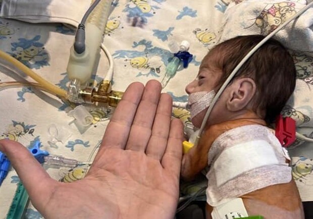 В Одессе прооперировали двух грудных детей с врожденными пороками сердца. 