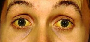 У Дніпропетровській області виявили хворих на гепатит А