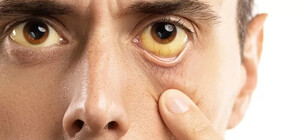 В Запорожской области зарегистрировали случаи заболевания Гепатитом А