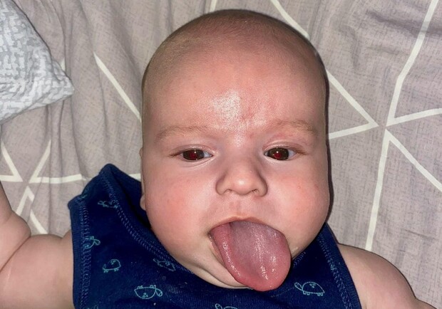 Малышу из Одесской области сделали уникальную операцию на язык: он был в пять раз длиннее. 