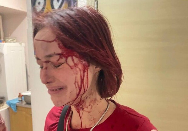 Одеситка заявила, що її побив милицями працівник ТЦК: розпочалася перевірка. 