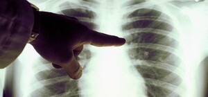 У Львівській області різко зростає кількість хворих з пневмоніями 