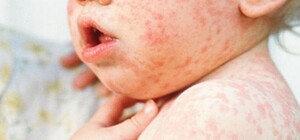 На Одещині зафіксовані нові випадки кору, один із яких летальний