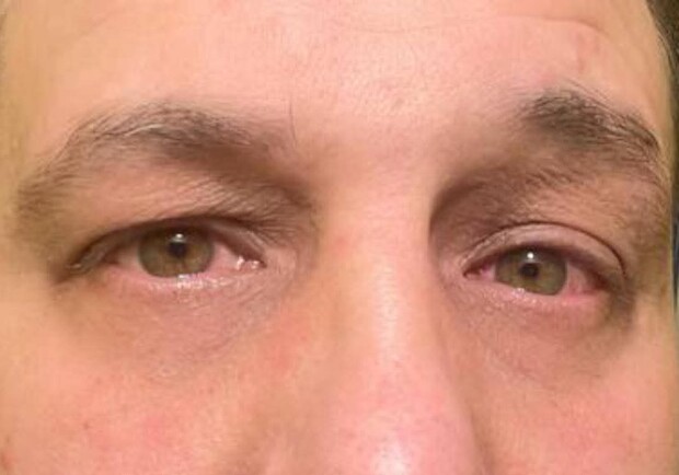 Глаза военного после применения перцового баллончика. 