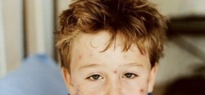 В Луганской области все чаще болееют  