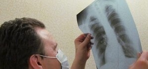 Одесская учительница ходила в школу с открытой формой туберкулеза