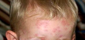 Луганская малышня покрылась красными точками. В садиках — карантин