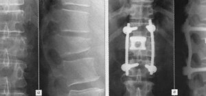 Под Запорожьем школьник переломал ровеснику позвоночник