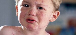 В Запорожье 10 000 человек переболели ветрянкой