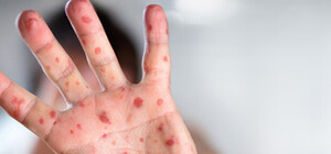 Угроза существует: что происходит с корью в Крыму