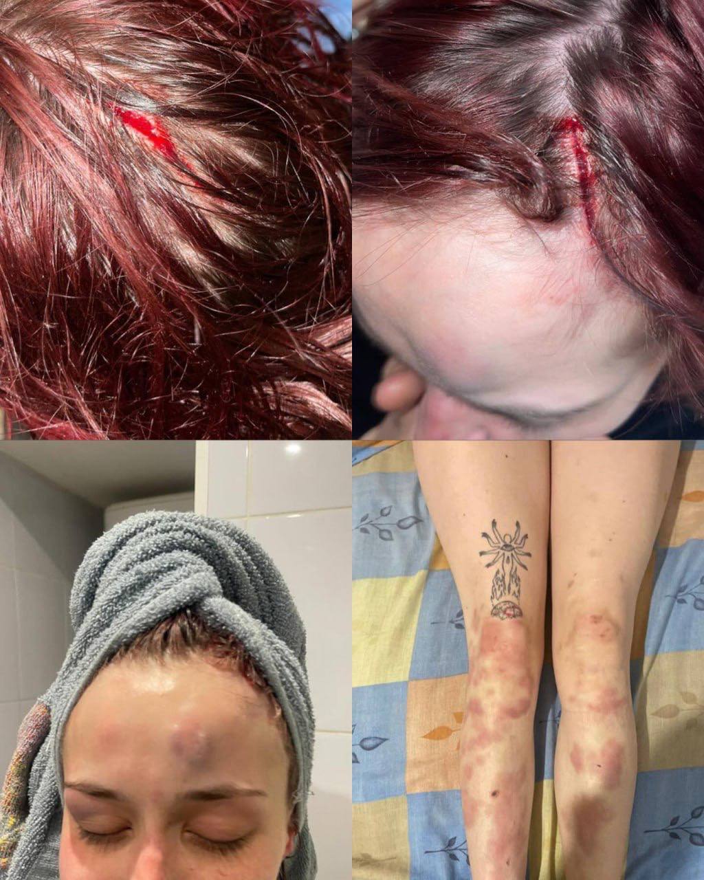 Одеситка заявила, що її побив милицями працівник ТЦК: розпочалася перевірка.