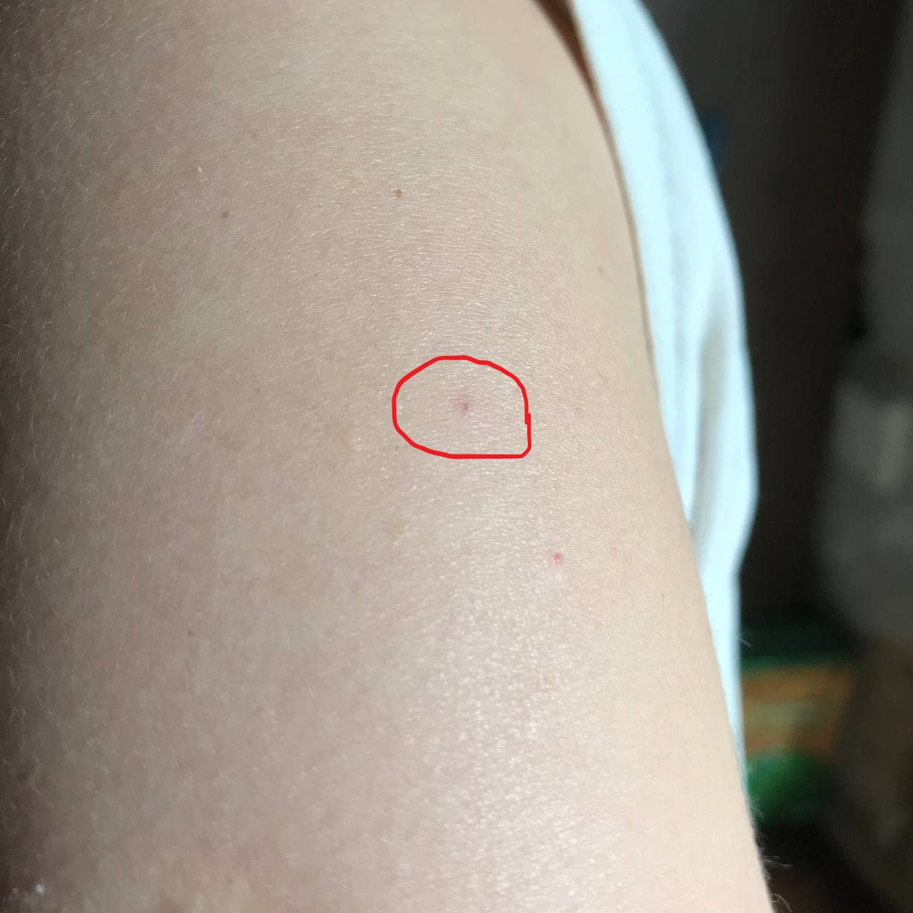 Место укола