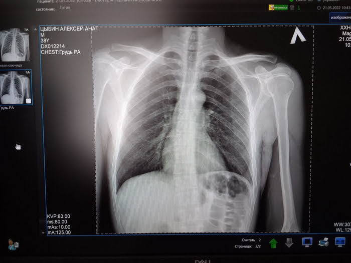 В Одессе из-за водителя Mercedes серьезно пострадал велосипедист.
