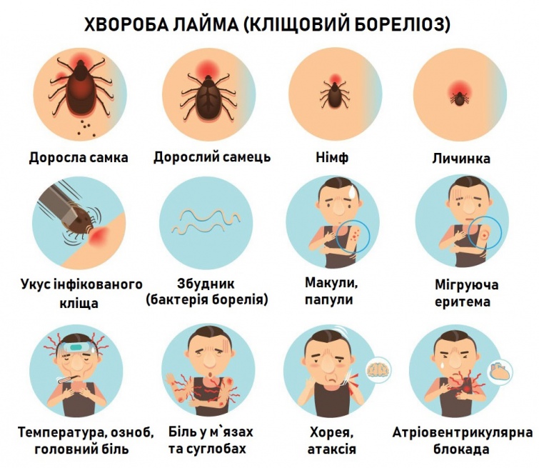 Признаки хвороби Лайма (кліщовий іксодовий бореліоз, лайм-бореліоз)