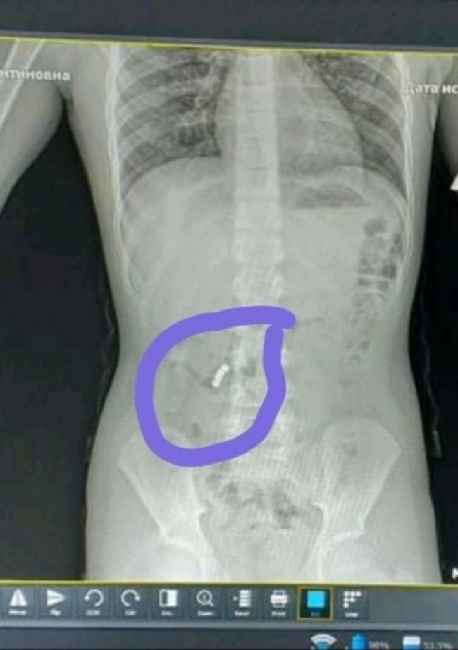 В Черноморске четвероклассник проглотил магниты.