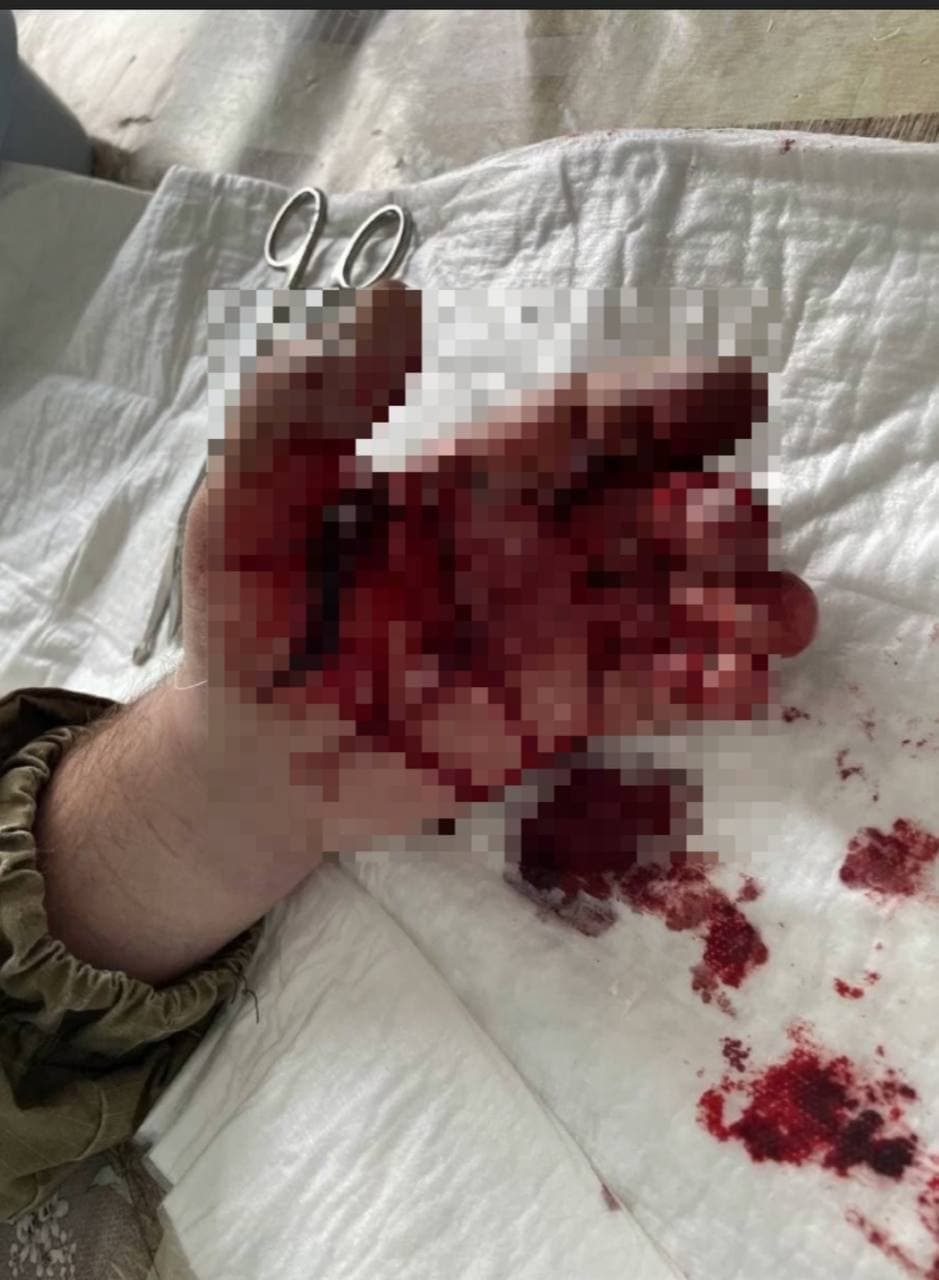 Во время учебных занятий под Одессой травмировался офицер-сапер.