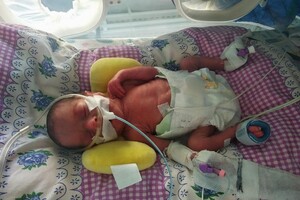 В Одесі медики врятували двох немовлят, які важили менше ніж 900 грам фото 3