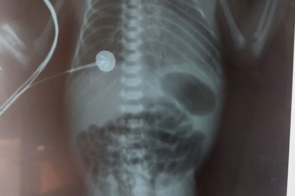 Одесские хирурги спасли двух младенцев с пороками развития фото 2