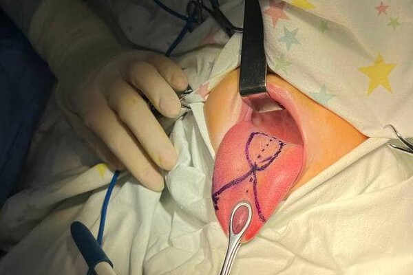 Малюкові з Одеської області зробили унікальну операцію на язик: він був уп'ятеро довшим фото