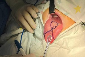 Малышу из Одесской области сделали уникальную операцию на язык: он был в пять раз длиннее фото