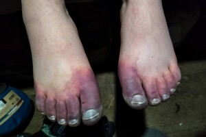 Ночував у лісі й обморозив ноги: у Карпатах врятували туриста з Одеси фото